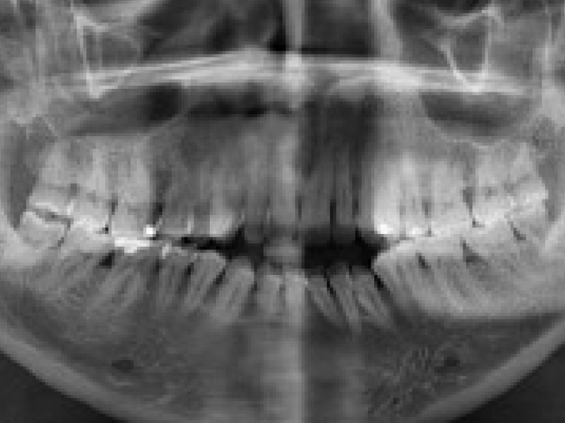 ¿Cuánto irradian las radiografías dentales?