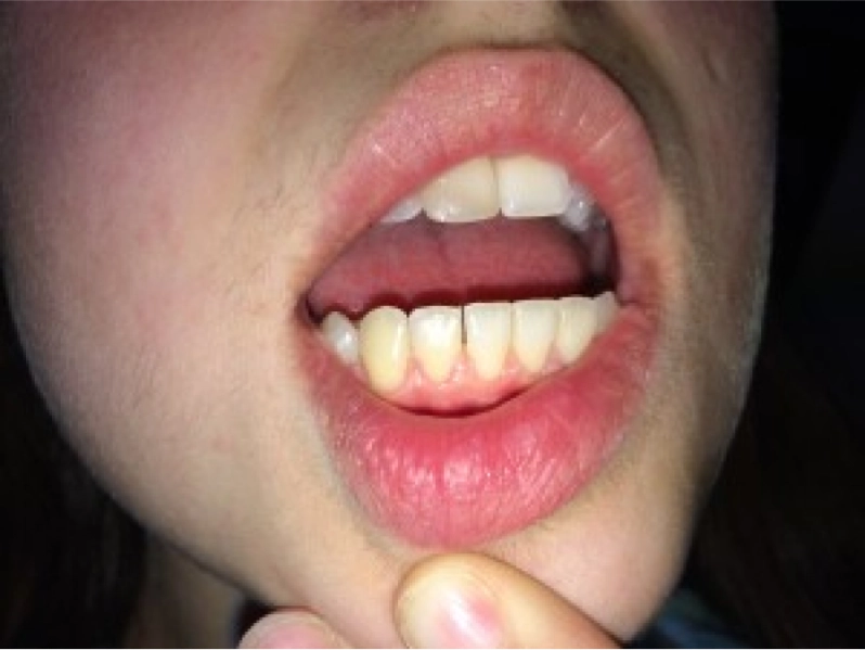 ¿Qué es el IPR o stripping dental en ortodoncia?