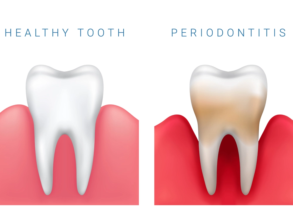Fotografía de un tratamiento de periodoncia