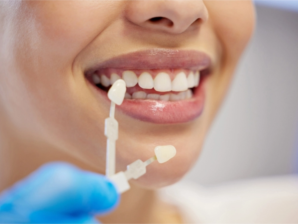 Fotografía de un tratamiento de estética dental
