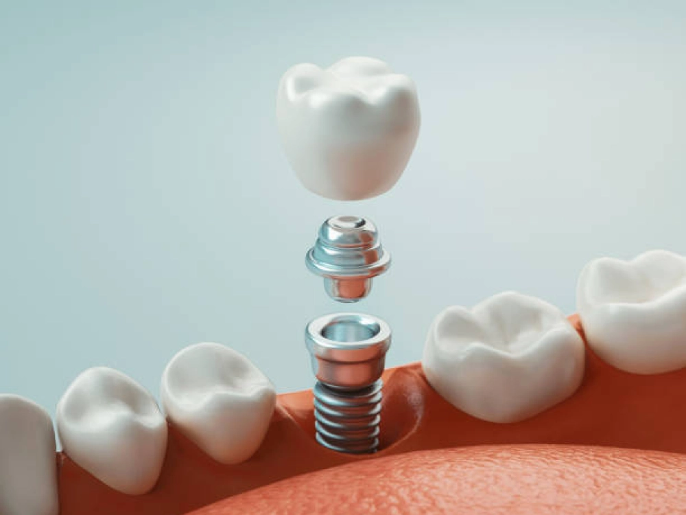Fotografía de un implante dental