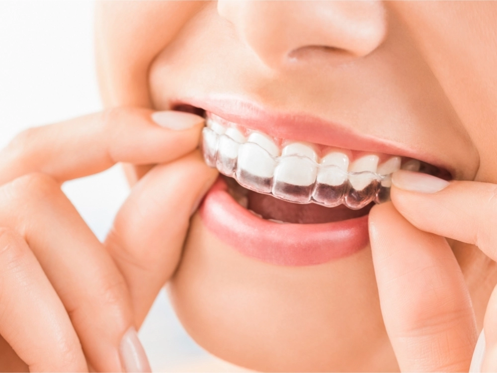 Fotografía de un tratamiento de estética dental