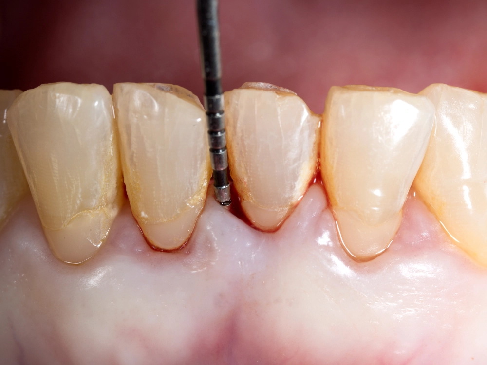 Fotografía de un tratamiento de periodoncia